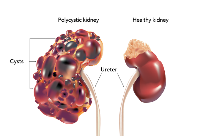Polycystic Kidney Disease | My Doctor Online