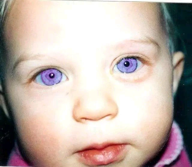 Wonderful, Photos Kids That Where Born With Strange Eyes (Opinion)