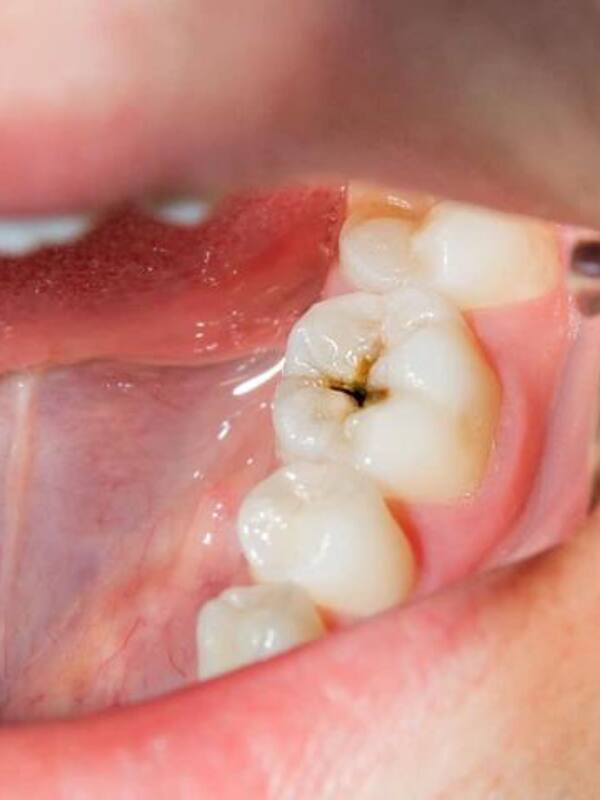 Tooth decay