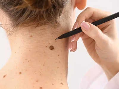 ​You have the same marks or spots
