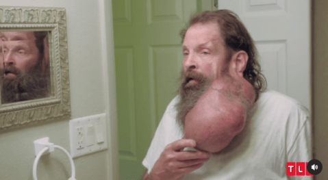 Take My Tumor, TIm