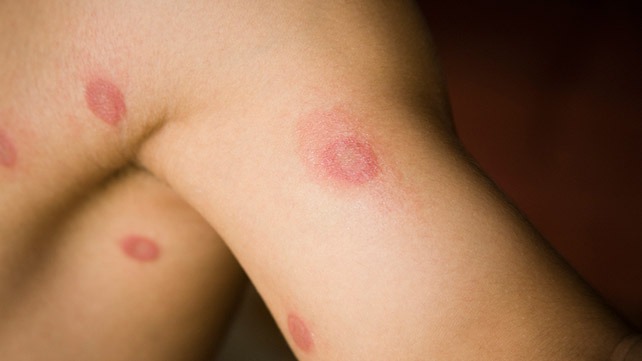 Skin Infection: Pictures, Causes and Treatments
