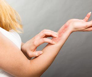 Contact Dermatitis