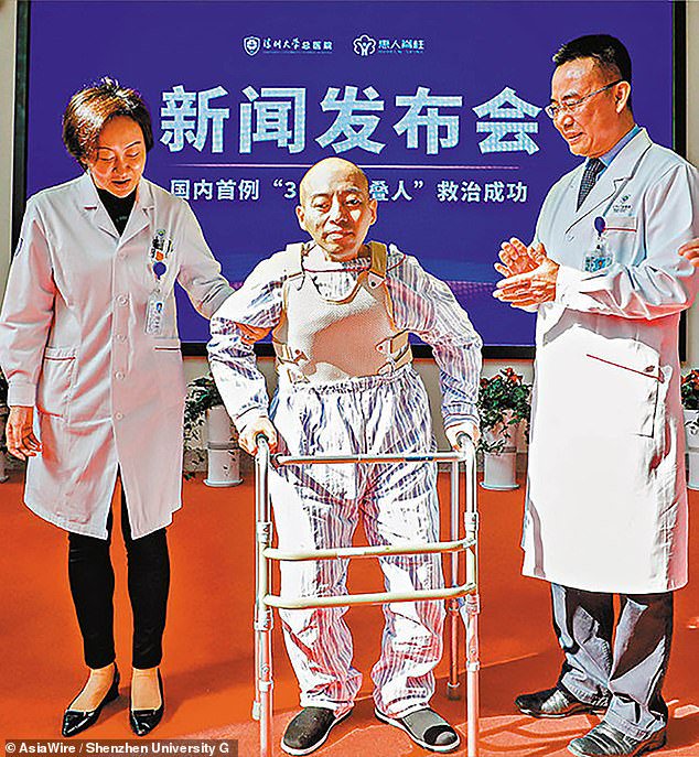 After a series of four operations this year, Mr Hua has been able to stand straight for the first time in 28 years. He is expected to walk without aid (a walker) in three months