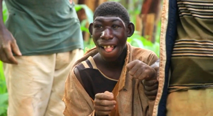 See The 21 Years Old Man Born As Human With The Features Of A Chimpanzee - [watch video]. 17