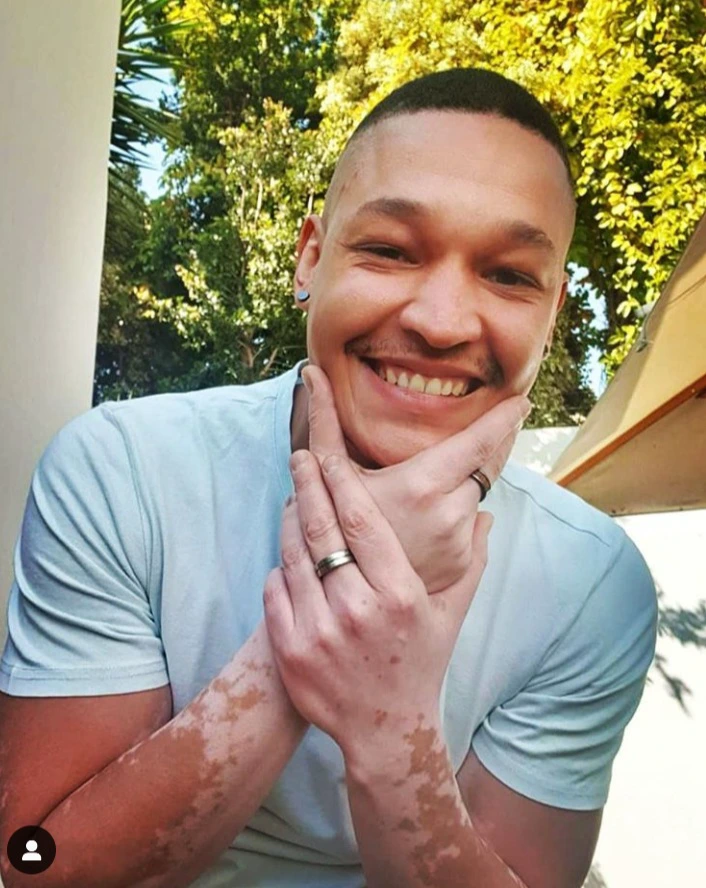 Top 5 Mzansi Celebrities Living with Vitiligo.