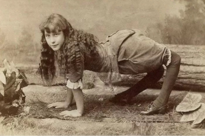 Ella Harper yang memiliki kelainan tulang dengan lutut terbalik. (Instagram/@asliceofhistory) (Instagram/@asliceofhistory)