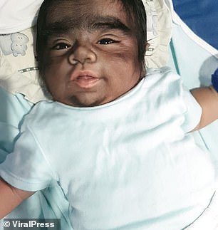 Jaren has had the thick 'werewolf' hair since birth