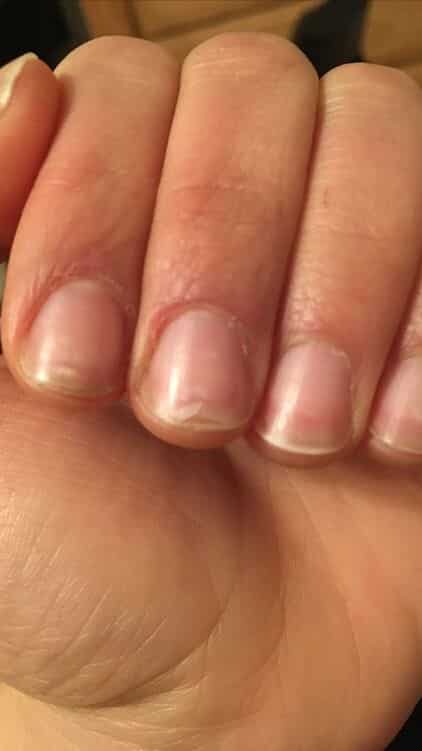 Weak and Brittle Nails