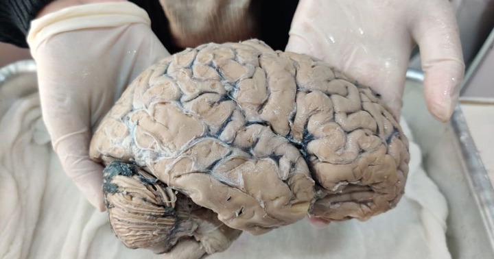 Doctor shares 'brain worm warning signs' and it's something that everyone should know